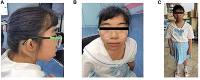 De novo 11q13.3q13.4 deletion in a patient with Fanconi renotubular syndrome and intellectual disability: Case report and review of literature